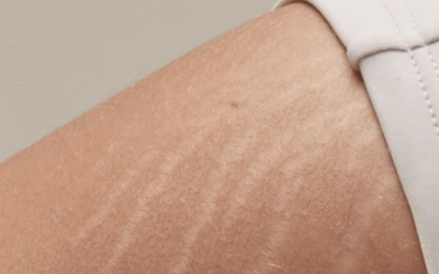 Vergetures de grossesse : les solutions dermo-esthétiques qui fonctionnent réellement