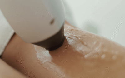 Épilation laser pour peaux matures : conseils et précautions